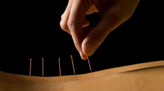 Hand placing acupuncture needles on back