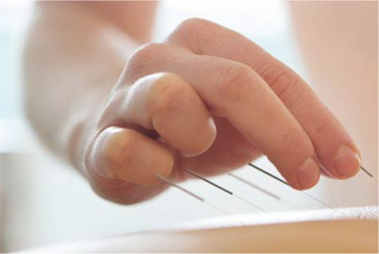 Hand inserting acupuncture needles into skin